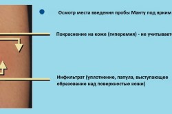 Осмотр места проведения пробы Манту под ярким светом