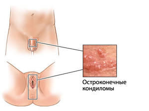 Польза Гардасила при генитальных кондиломах