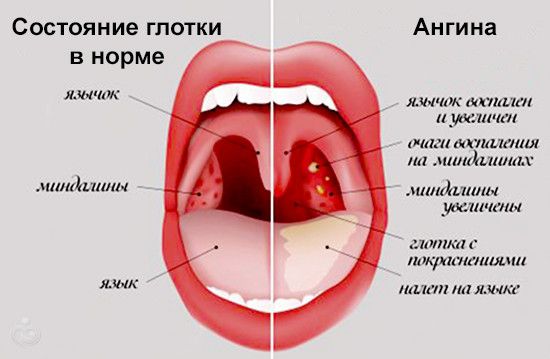 Стафилококк прививка