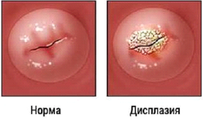 Дисплазия матки