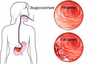 Антибиотик ассоциированная диарея лечение