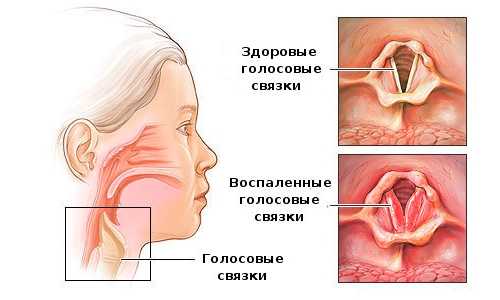 Антибиотик от ларингита и фарингита