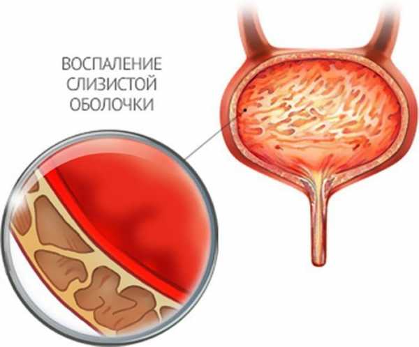 Антибиотик порошок цистит