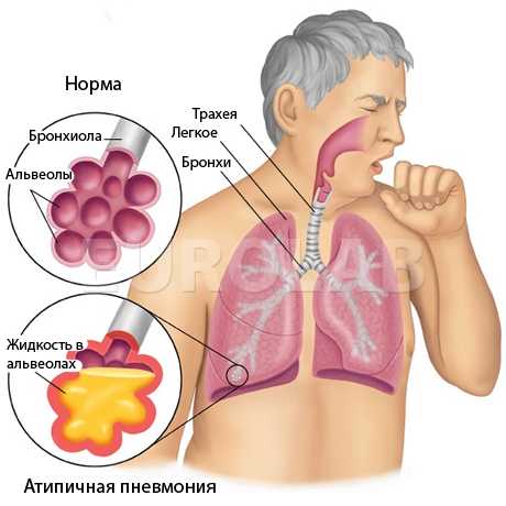 Антибиотик при атипичной пневмонии