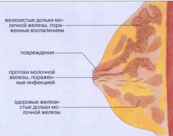 Антибиотик при мастите у некормящих женщин