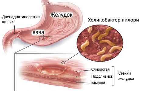 Антибиотик при язве двенадцатиперстной кишки