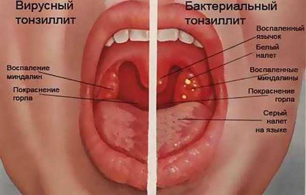 Антибиотики бактериальная ангина