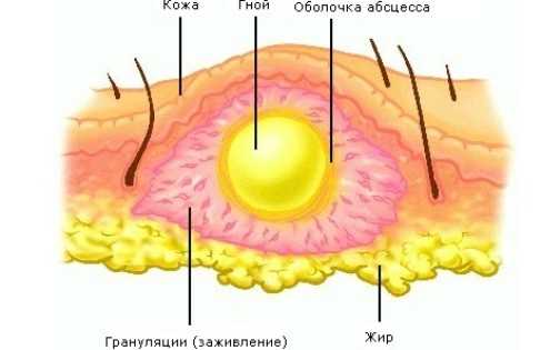 Антибиотики при абсцессе ягодицы