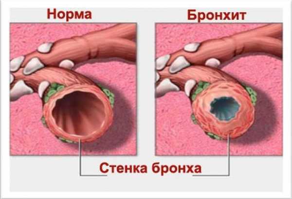 Антибиотики при бронхите список препаратов