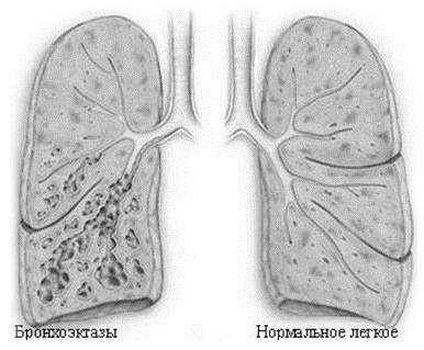 Антибиотики при бронхоэктатической болезни