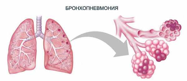 Антибиотики при бронхопневмонии