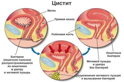 Антибиотики при цистите фурамаг