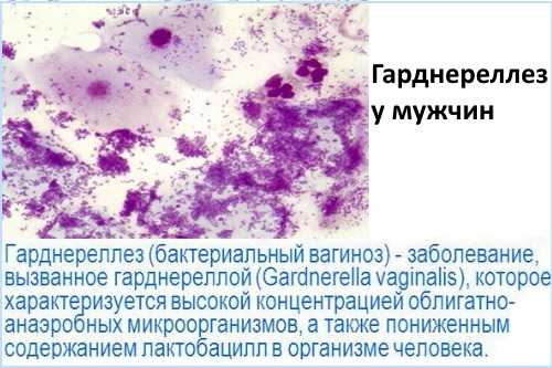 Антибиотики при гарднереллезе у мужчин