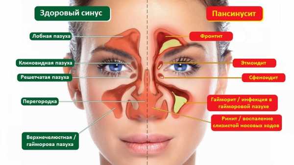 Антибиотики при головных болях