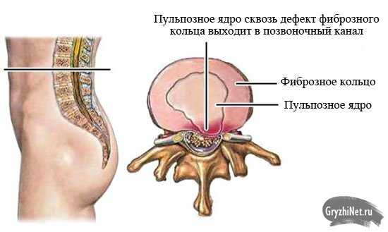 Антибиотики при грыже позвоночника