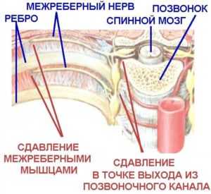 Антибиотики при межреберной невралгии