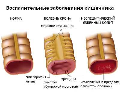 Антибиотики при няк