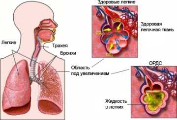 Антибиотики при отеке легких