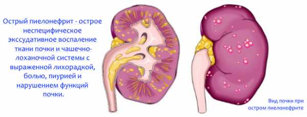Антибиотики при пиелонефрите при гв