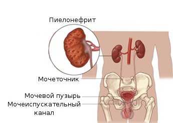 Антибиотики при пиелонефрите у беременных