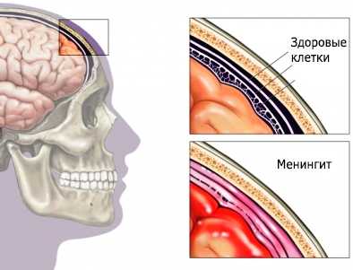Антибиотики при серозном менингите