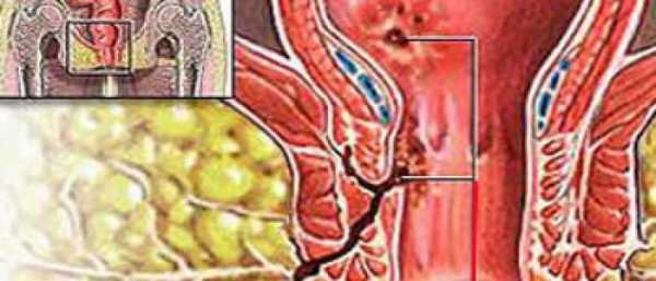 Антибиотики при свище заднего прохода