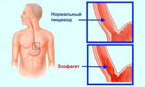 Антибиотики при воспалении пищевода