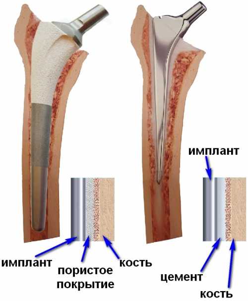 Цемент костный с антибиотиком