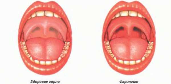 Горло болит больно глотать что делать чем лечить антибиотики