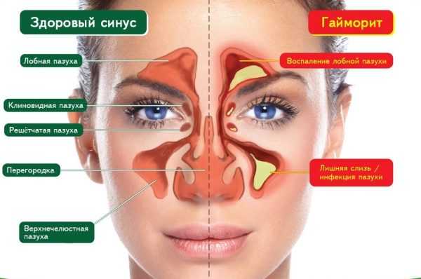 Ингаляции при гайморите с антибиотиком