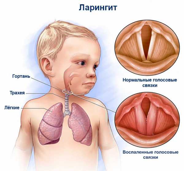 Как вылечить ларингит у ребенка без антибиотиков