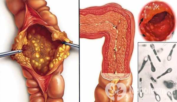 Колит на фоне приема антибиотиков