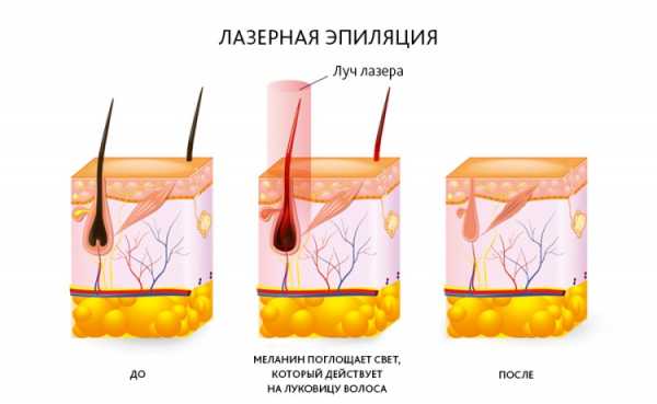 Лазерная эпиляция и антибиотики