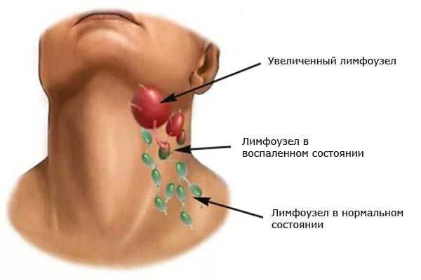 Лечение антибиотиками воспаление лимфоузлов