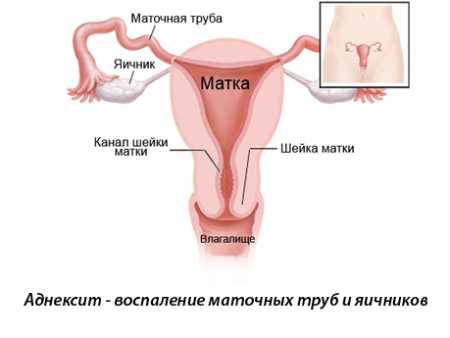 Лечение антибиотиками воспаление придатков