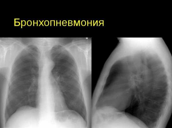 Лечение бронхопневмонии у детей антибиотиками