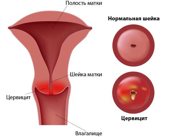 Лечение цервицита у женщин антибиотиками