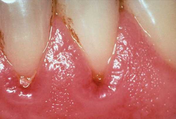 Лечение гингивита антибиотиками