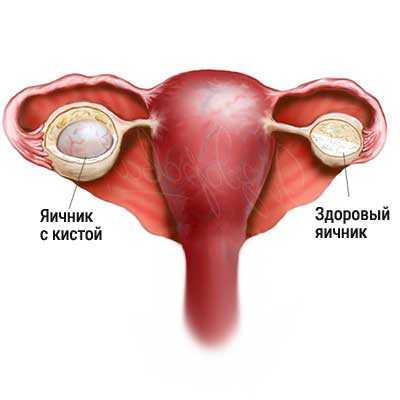 Лечение кисты яичника антибиотиками