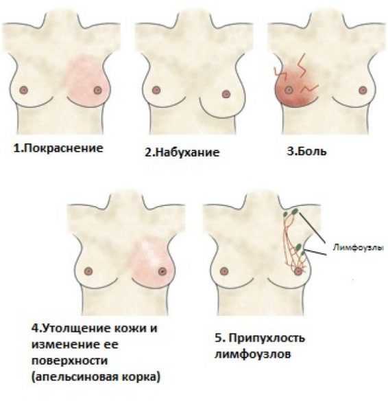 Лечение мастита антибиотиками у кормящей мамы