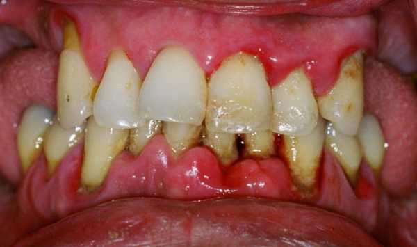 Лечение пародонтита антибиотиками