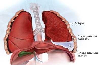 Лечение плеврита антибиотиками