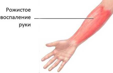 Лечение рожистого воспаления руки антибиотиками