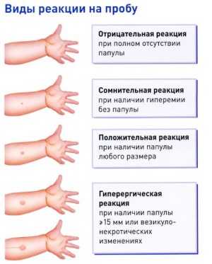 Манту прививка чешется