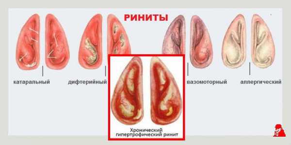 Носоглотка воспаление лечение антибиотиками