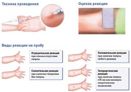 Периодичность прививки манту