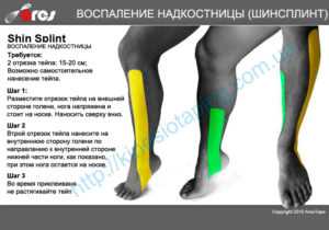 Периостит голени лечение антибиотиками