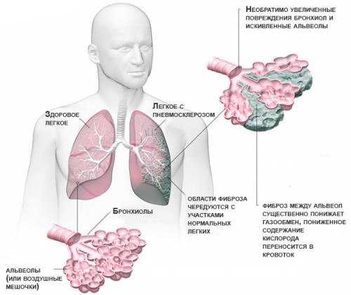 Пневмосклероз легких лечение антибиотиками