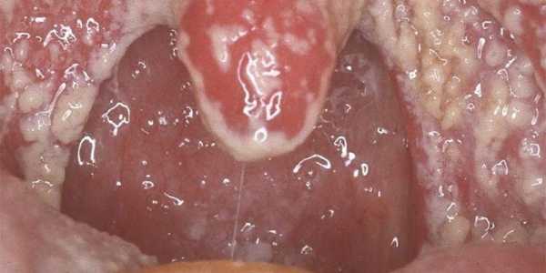 После антибиотиков грибок во рту