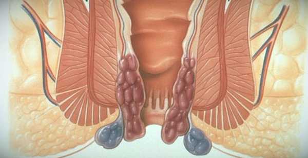 После антибиотиков жжение в заднем проходе